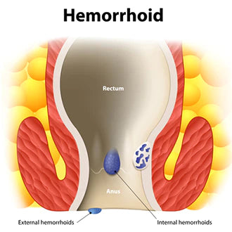 Piles & Haemmorhoids