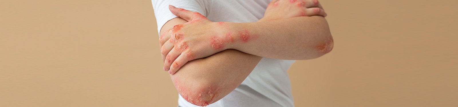 Dry Skin & Eczema