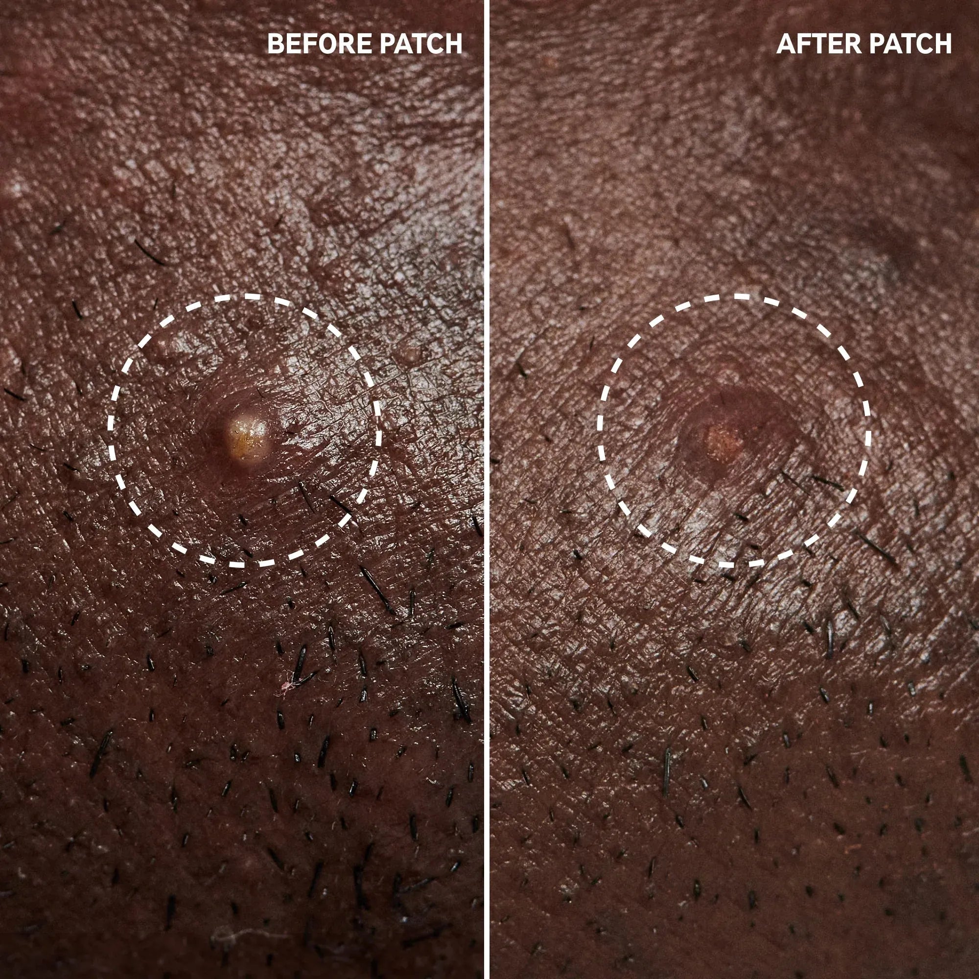 The INKEY List Hydrocolloid Invisible Pimple Patches