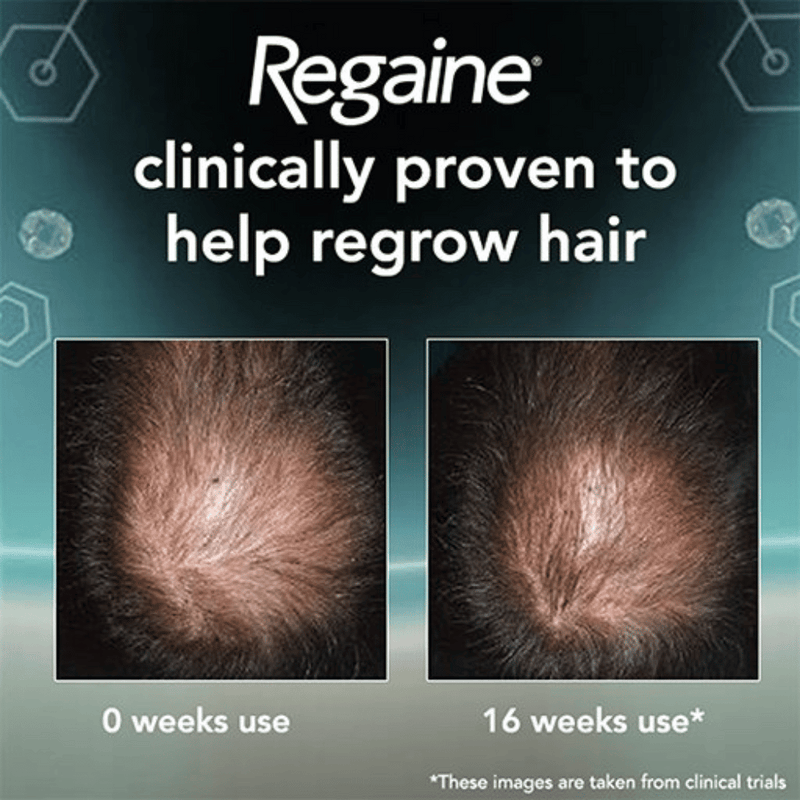 Regaine (minoxidil) 5% Foam For Men - 12 Month Supply