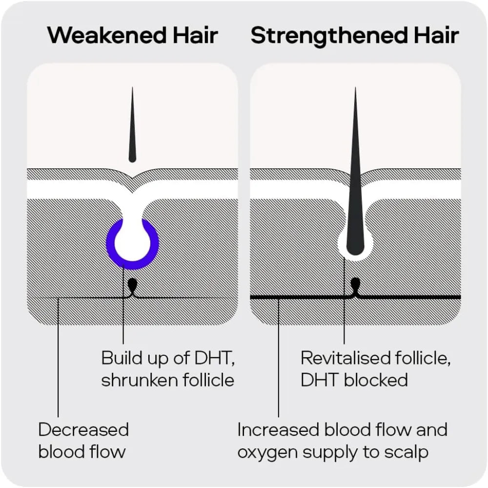 Sons Complete Hair Loss Treatment. Minoxidil 5%-3 Month Supply